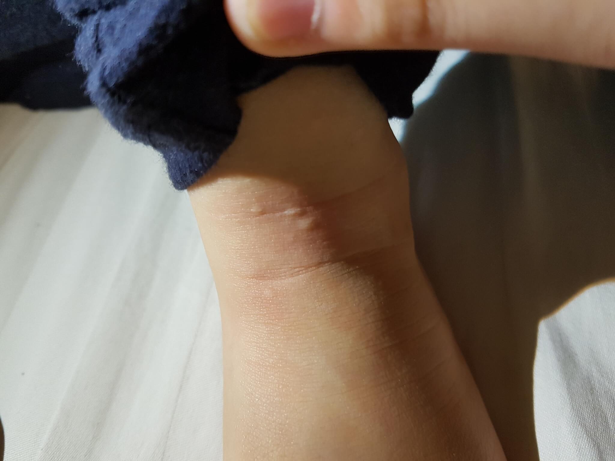 Bed Bugs in Luang Prabang: What We Learned